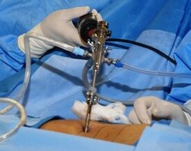 Chirurgische behandeling van lumbale osteochondrose
