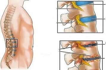 De redenen voor de ontwikkeling van lumbale osteochondrose