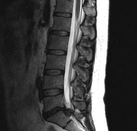 Diagnostische opties voor lumbale osteochondrose