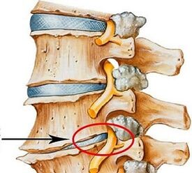 Waarom is lumbale osteochondrose