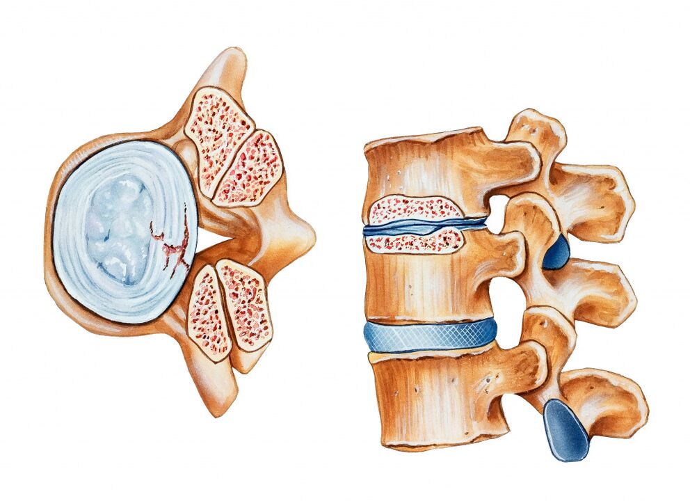 Osteochondrose van het cervicale gebied leidt tot de vernietiging van de tussenwervelschijven