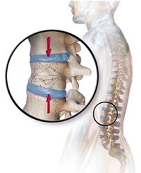 Osteoporose veroorzaakt rugpijn in de onderrug